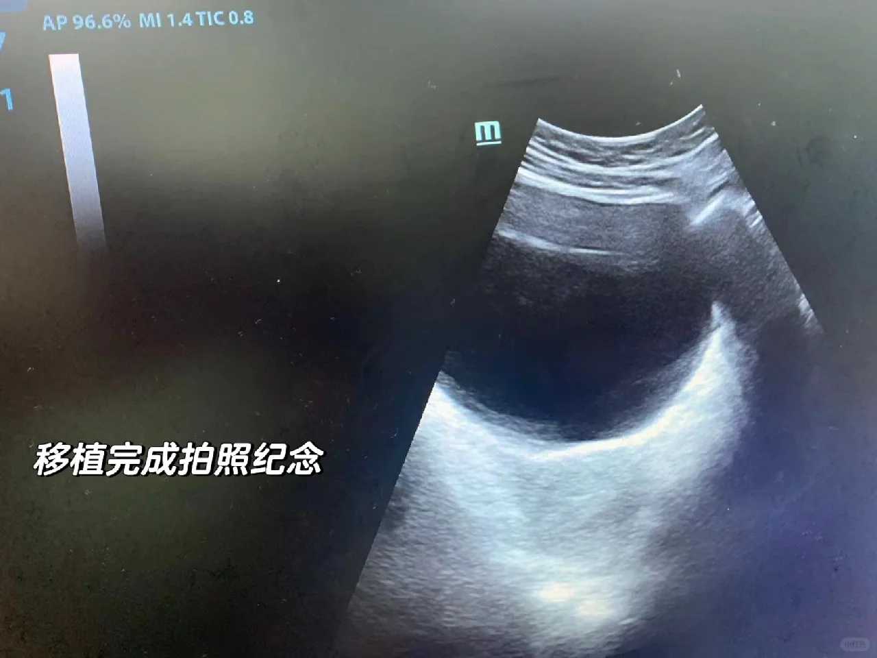 代怀孕流程表&做试管代生的流程,子宫次全切除一年，同房还会不会怀孕？